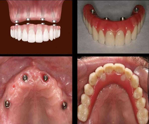 all-4-dental-implants