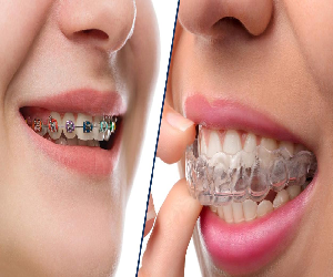 invisalign-treatment