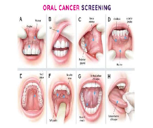 oral-cancer-screening-9.png