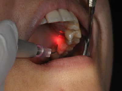 Laser Dentistry