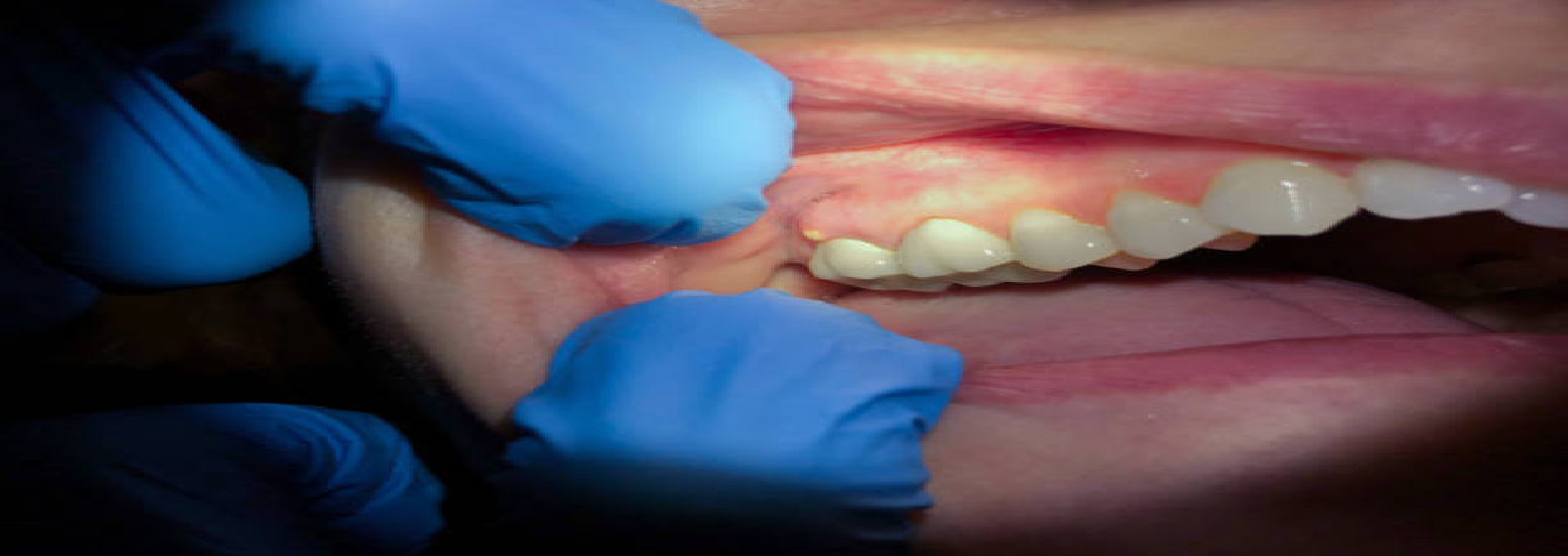 tooth-abscess-banner