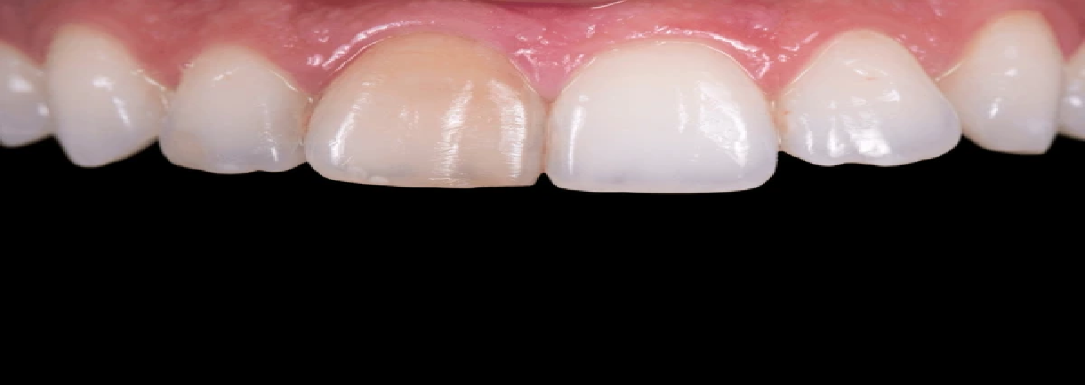 tooth-discoloration-banner