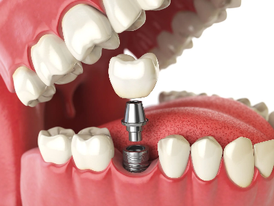 dental-implants.png