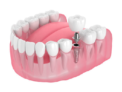 3D-dental-implants