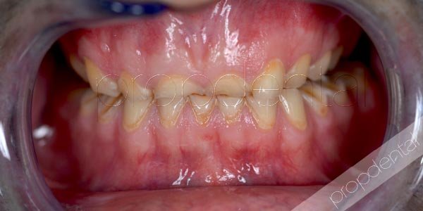 Teeth Grinding